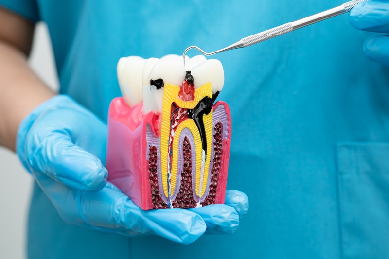 Endodoncia en CDMX