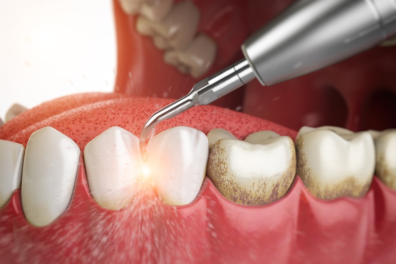 Periodoncia
